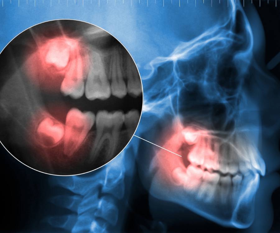 Why Are Wisdom Teeth Such a Problem?